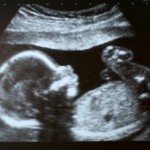ultrasound, unborn child, baby, abortion